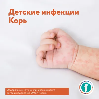 Корь: симптомы у детей и возможные осложнения от вируса - Газета.Ru