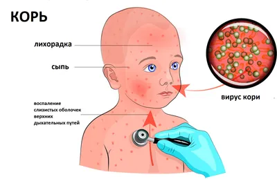 В одном регионе Казахстана выявляют все больше случаев кори у детей