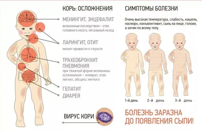 В Алматы наблюдается вспышка кори у детей