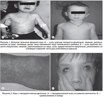 Аллергия или корь? Как понять, что за сыпь на теле у ребёнка? | Детская  медицина Вирилис | Дзен