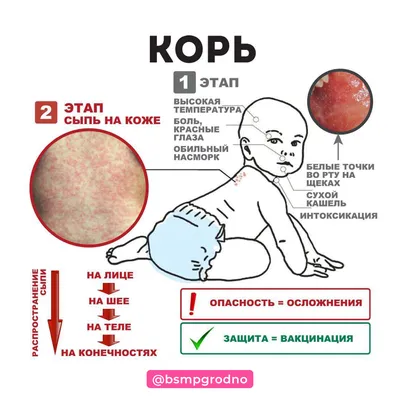 Что такое корь? — «Наше время», новости Наше время