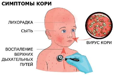 Корь: симптомы, фото, у детей и взрослых, прививка, лечение