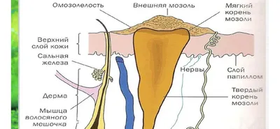 Как убрать бородавку: методы лечения