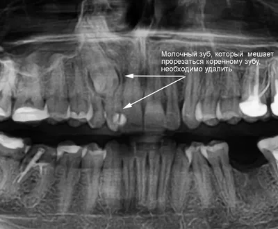 Молочный зуб | Пикабу