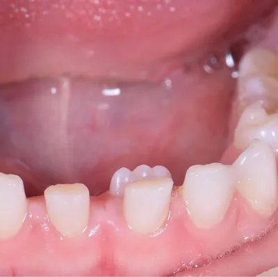 Что делать, если начал шататься зуб у ребёнка? | Стоматолог Егор Щетинкин |  Дзен