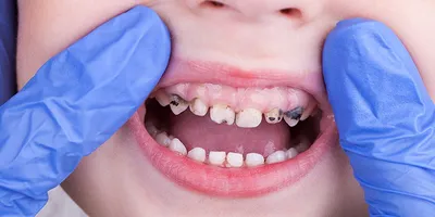 Потемнение молочных зубов - SHiFA