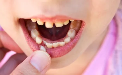 Удаление передних зубов
