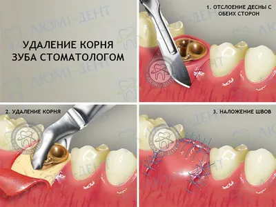 Шатается зуб — что делать, симптомы, методы лечения и укрепления зубов у  взрослых и детей