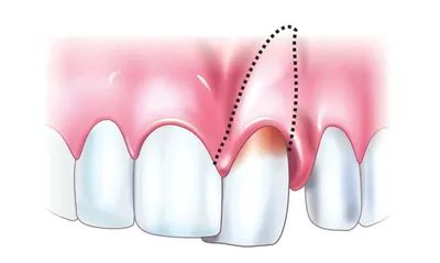 Удаление Зубов Элеватором Передние Коренные ЛюмиДент