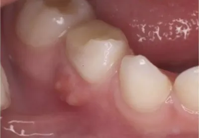 Удаление Зубов Элеватором Передние Коренные ЛюмиДент