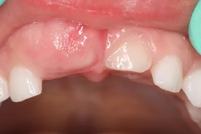 Удаление корня зуба, лечение в клинике современной стоматологии Ваш выбор в  Благовещенске