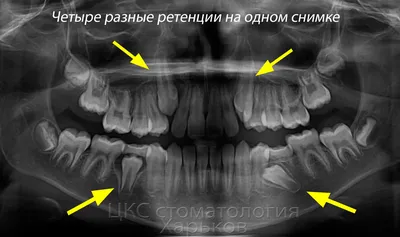 Молочные зубы у взрослых | Семейная стоматология