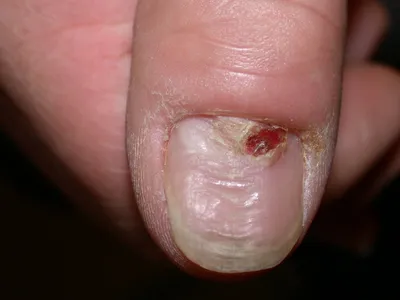 Мрачные полосы на ногтях: стоит ли беспокоиться о продольной меланонихии? |  Доктор: просто о сложном | Дзен