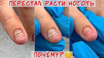 nail_asiya__ - НУЖНО ЛИ МАСТЕРУ ЗНАТЬ СТРОЕНИЕ НОГТЕВОЙ ПЛАСТИНЫ?! ⠀ К  сожалению многие мастера с опытом и без опыта не знают строение ногтя и  просто делают маникюр, поэтому начинают пропиливать матрикс (корень