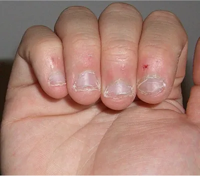 Онихогрифозные ногти 🫣 Просто покрыть базой не получится и даже если  убрать их под корень. Очень нужно работать гелем❗️ НО ЧТО ВЫБРАТЬ… |  Instagram