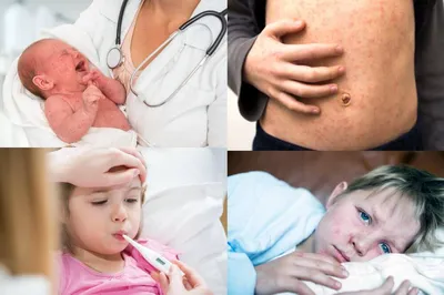 Фараби - MMR II - это комплексная вакцина, которая защищает сразу от трех  вирусов: кори, краснухи и паротита. ✓М (measles) – корь. Серьезное  инфекционное и крайне заразное заболевание. Среди опасных осложнений:  коревой
