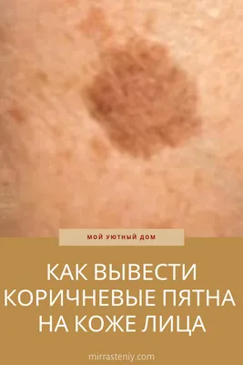 Лазерное удаление пигментных пятен на теле в Москве
