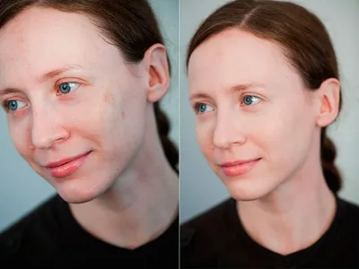 Пигментные пятна - Hillary Cosmetics - Инновационная натуральная косметика ❤