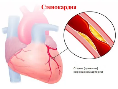 Коронарография сердца в Старом Осколе