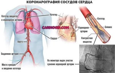 Аортокоронарное шунтирование (АКШ)