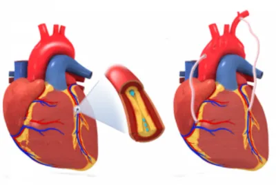 Плановое и экстренное коронарное шунтирование в Израиле : Armedical