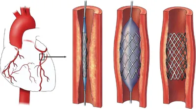 Коронарные артерии — это кровеносные сосуды, которые снабжают сердце  кровью, чтобы оно могло перекачивать | Премиум Фото