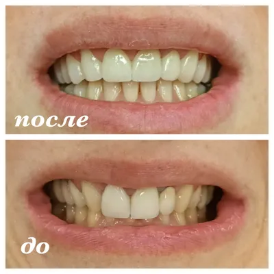 Коронки из диоксида циркония (в том числе на имплантах) для протезирования  жевательных зубов