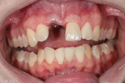 Протезирование зубов цирконием в Москве, цены на установку в стоматологии  20-32/Oganoff Clinic