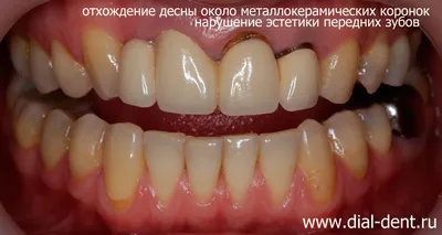 Протезирование на имплантах в зоне улыбки. коронка из диоксида циркония