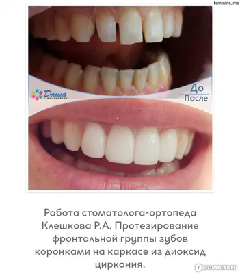 Наши пациенты, фото до и после лечения в стоматологии Эксперт на  Алексеевской