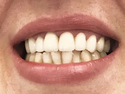 Поставить коронки из диоксида циркония на передние зубы в ТОП1 клинике  Москвы - Немецкий Имплантологический Центр
