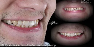 Восстановление разрушенного зуба циркониевой вкладкой и коронкой из диоксида  циркония