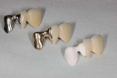 До и после установки коронок из диоксида циркония в стоматологии Гармония в  Феодосии