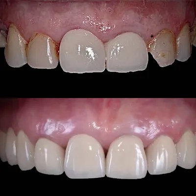 Циркониевые коронки на зубы - Цены на коронки из диоксида циркония в  стоматологии Lotus Dent
