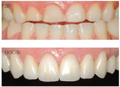 Циркониевые коронки в Воронеже | цена, фото до и после