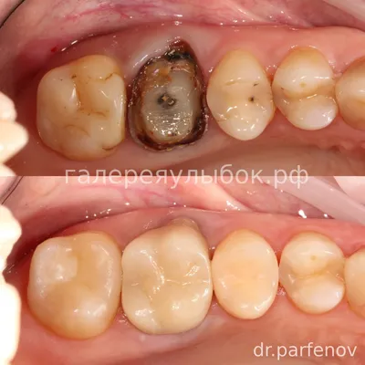 Коронки из диоксида циркония на центральные зубы, фото до и после Иркутск