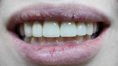 Циркониевые коронки | Преимущества | Клиника семейной стоматологии Дока-Дент