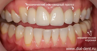 Циркониевые коронки в Хабаровске | Цена в стоматологии Oral Clinic