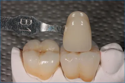 Особенности зубных коронок из диоксида циркония | НАВА