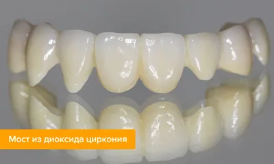 Циркониевые коронки по цене керамики на зубы! | Протезирование в  стоматологии Маэстро-Дент