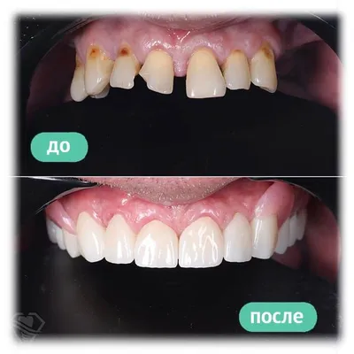 Коронки из циркония 21, 11, 13, 15 зубы | Примеры работ - фото до и после
