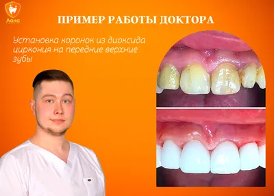 Циркониевые коронки на зубы ᐉ Цены зубных коронок из диоксида циркония в  Калининграде