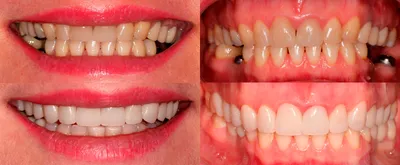 Металлокерамика или цирконий: какая коронка лучше для зубов?