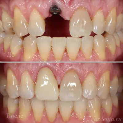 Эстетическая стоматология в действии: создание нового дизайна улыбки с  коронками из диоксида циркония | Стоматология 31
