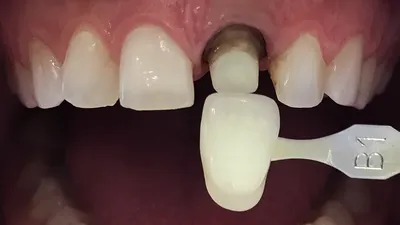 Диоксид циркония. Коронка на имплантате на жевательный зуб.