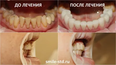 Установка виниров и коронок женщинам после 50 лет. Клиника Smile STD в  Измайлово