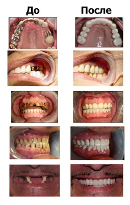 МЕТАЛЛОКЕРАМИКА ЗУБОВ В МИНСКЕ, КОРОНКИ, ЦЕНЫ, ФОТО ДО И ПОСЛЕ