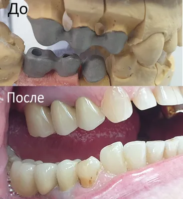 Недорогое протезирование металлокерамикой в Москве