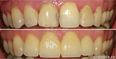 Коронки на молочные зубы фото до и после | Центр дентальной имплантологии  Эстетус