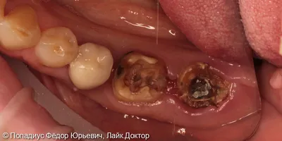 Коронки из диоксида циркония (в том числе на имплантах) для протезирования  жевательных зубов